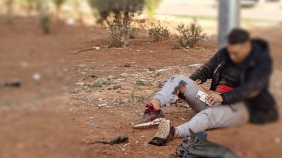 عملية نشل بواسطة دراجة نارية تنتهي ببتر قدم الجاني بمدينة فاس