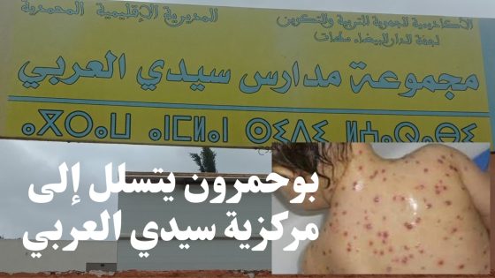 استبعاد ثلاثة تلاميذ مصابين بمرض الحصبة (بوحمرون) من مركزية سيدي العربي بجماعة سيدي موسى بن علي عمالة المحمدية